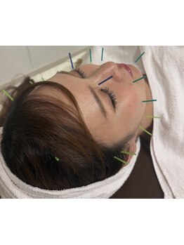 鍼灸施術を受けたい