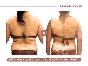 イエス マイサロン(yes My Salon)/脂肪冷却+痩身施術症例