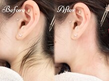 ピミル(PIMIL)/うなじ脱毛