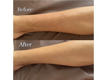 レーヌ(Reine)/足脱毛