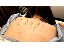 中国鍼灸院 はこしま医針堂/身体の鍼灸