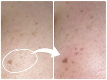 ジュパール(je pars)/低周波シミケア/シミ改善