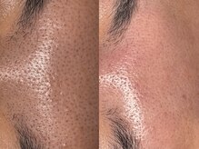 サラグランデ(Sara Grande)/額、眉間のエクストラクション