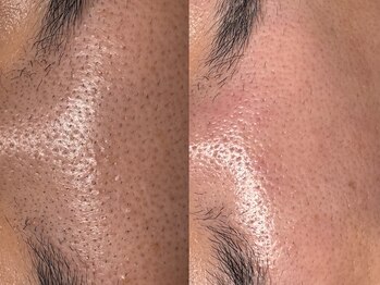 サラグランデ(Sara Grande)/額、眉間のエクストラクション