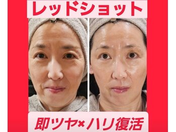 アン 銀座(ann)の写真/【速攻性と持続力に定評あり！】レモンボトルとエクソソームとの掛け合わせで肌の内側から美肌へ導きます♪