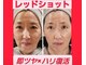 アン 銀座(ann)の写真/【速攻性と持続力に定評あり！】レモンボトルとエクソソームとの掛け合わせで肌の内側から美肌へ導きます♪