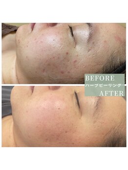 ビューティーサロン エー(A)/ハーブ＜ビフォーアフター＞