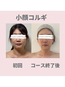 ディードットアン(D.an)/小顔コルギ回数券