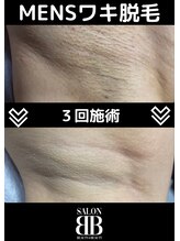 ビービー(BB)/メンズわき脱毛