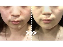 リエイト(Re:eight)/ハーブピーリング