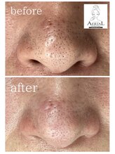 エアリアル 玉名店/いちご鼻に悩む方にオススメ♪