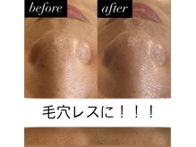 ブルーシー(BLUESEA)/毛穴洗浄