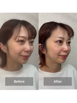 アネラ(ANERA)/小顔矯正&毛穴洗浄BeforeAfter