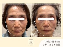 ベベティー(BEBETIE)/新メニュー☆小顔アイロン