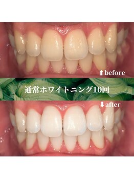 フタバ 天神大名店(futaba)/セルフホワイトニング10回