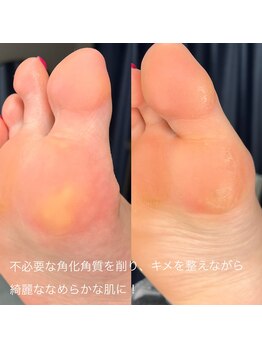 サロン ド ネイル 椿(Salon de nail 椿)/ふっくら、柔らかな足裏に！