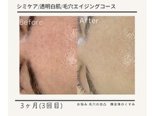 ルミエールフォートサイド(L’MIERE fortside)/お悩み:毛穴凹凸,肌のくすみ