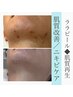 韓国肌管理≪ララピール≫ニキビケア/脂性肌/毛穴に◆90分￥16500→￥8900