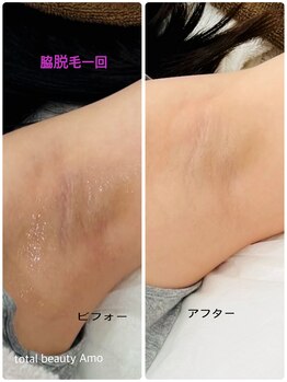 アモ(amo)/脇脱毛1回