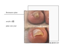 ネイルベース ネイル ケア サロン ミウラ(miura)/【巻き爪解放】レジスタンス