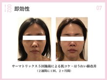 ラディアント たまプラーザ/こけた頬、おでこ、ハリ復活