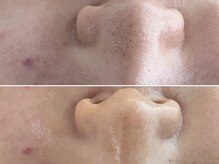 ハウオリ(Hauoli)/さよなら毛穴