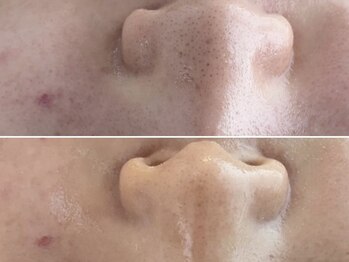 ハウオリ(Hauoli)/さよなら毛穴