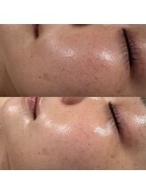 スキニティ(Skinity)/Reviハーブピーリング１回