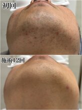 ルシャトン(Le Chaton)/ヒゲ脱毛