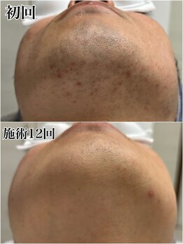 ルシャトン(Le Chaton)/ヒゲ脱毛