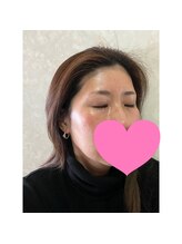 エクラルム(Eclaleum)/After　PHA水光ピーリング