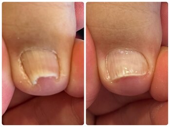 ピンクマジック(PINKMAGIC)/ヘイスイッチでの巻き爪ケア