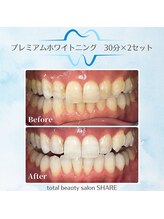 シェア(SHARE)/セルフホワイトニング