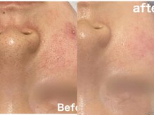 ホーミー(Homie)/毛穴黒ずみ、毛穴開き改善