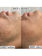 ハニーアイズ(Honey Eyes)/初回限定★ヒゲ脱毛爆抜けモード