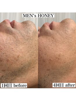 ハニーアイズ(Honey Eyes)/初回限定★ヒゲ脱毛爆抜けモード