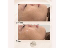 40代女性/施術2回の変化♪「メイクするのが楽しくなりました」