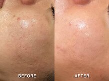 エリンダ(E LINDA)/毛穴洗浄