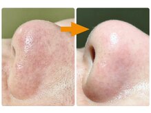 毛穴の黒ずみ・ニキビケア・シミケア・【最新型美容液洗浄】