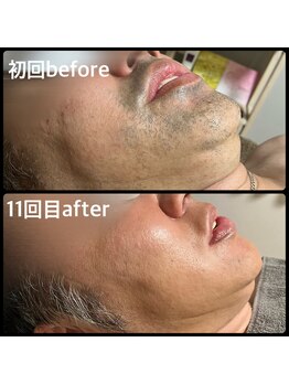 クリアボックス(Clear box)/【脱毛】