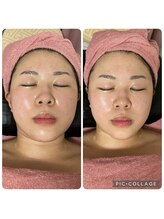 BBC 田園調布/小顔コルギの効果