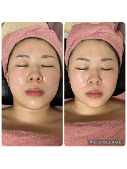 BBC 田園調布/小顔コルギの効果