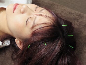 しんちまち鍼灸整骨院/頭部への鍼