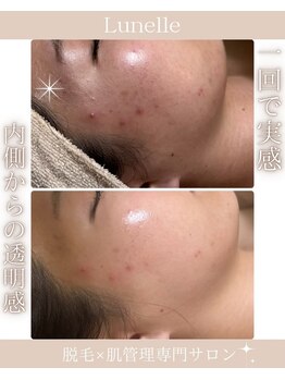 ルネル(Lunelle)/一回で実感!内側からの透明感