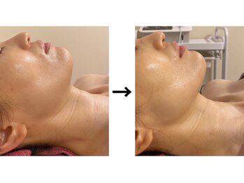 ドクターエイジレス(DR.AGELESS)/バイオセルショットコース6回