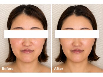 イル 名取店(iru)の写真/【二重あご・フェイスラインに】鏡や写真で気になる輪郭のもたつきを集中ケア！すっきり小顔印象へ