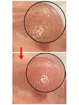 ハーシークレット(Her secret)/ハイドラ毛穴洗浄