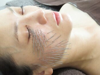 和楽治療院 神楽坂/刺繍美容鍼