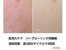 洗顔サロン 池袋(SENGAN)/ハーブピーリング　剥離無