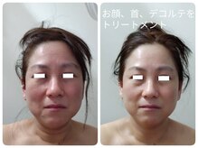 ティアス(t-us)/【覚醒】幹細胞フェイシャル